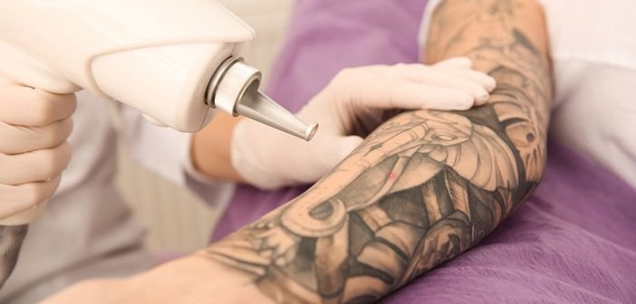 Detatouage-au-laser