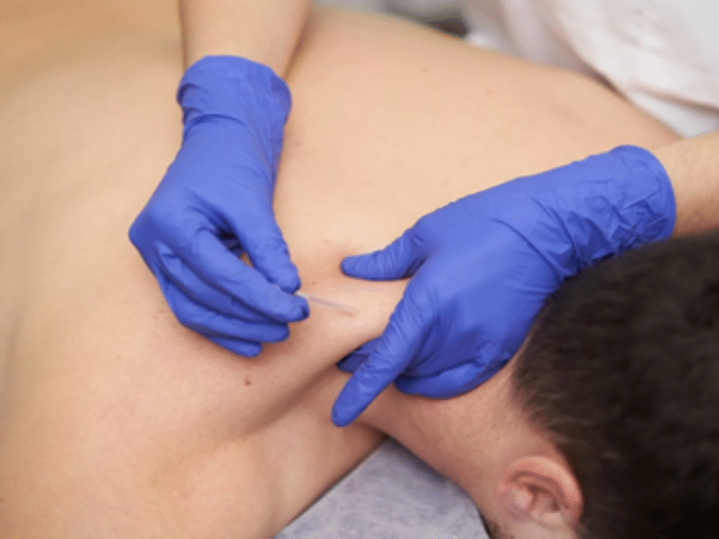 Dry-needling-for-shoulder-and-upper-back-pain-1200x900