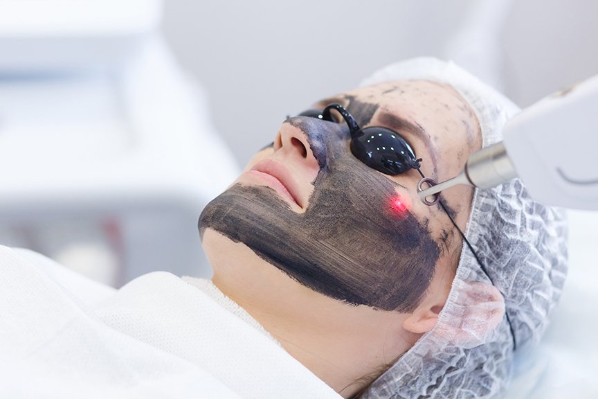 Carbon face peeling procedure. Laser pulses clean skin of the face. Hardware cosmetology treatment. Process of photothermolysis, warming the skin, laser carbon peeling. Facial skin rejuvenation.