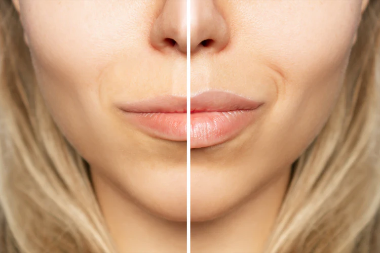 Lip_Filler_Montreal