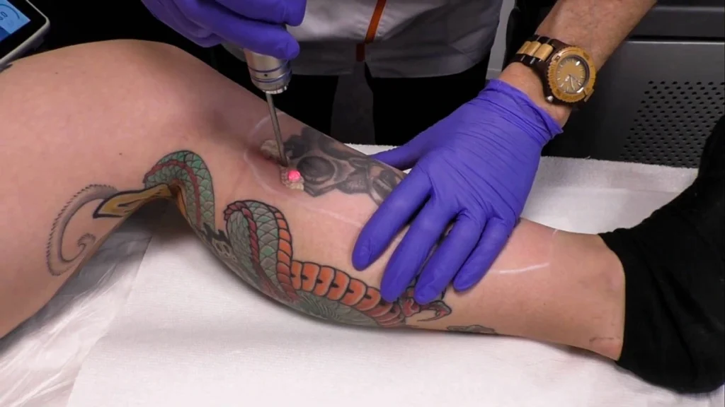 detatouage-laser-efficace