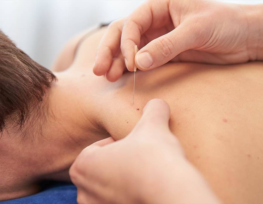 dry-needling-1