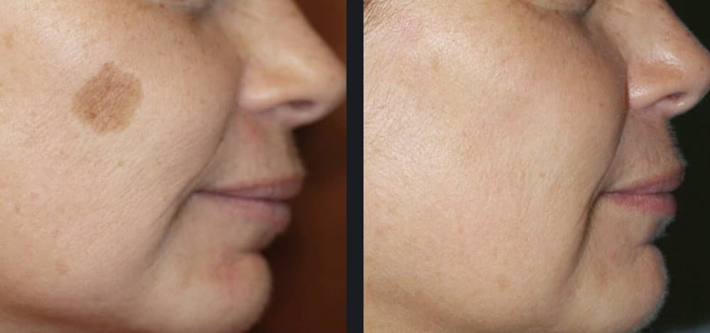 gentlemax-age-spots-jill-waibel-md-p1