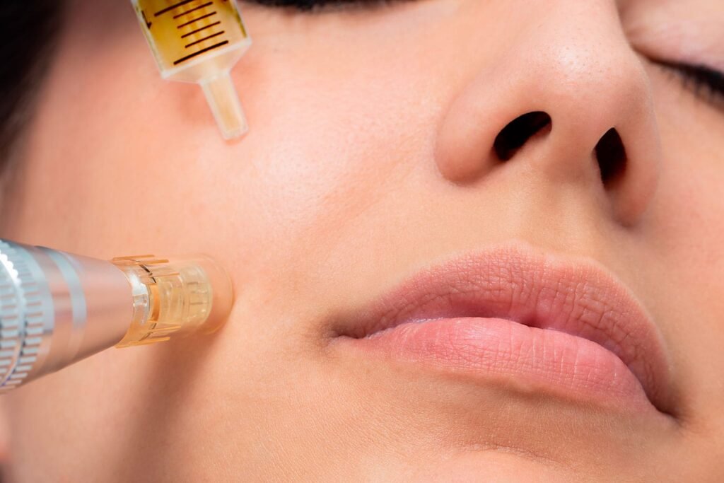 microneedling-explication-du-soin-dermapro