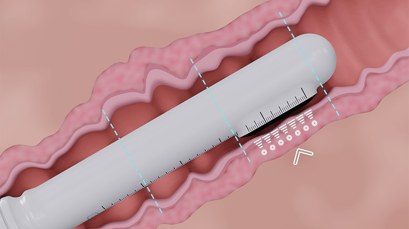 trattamento-hifu-vaginale-biomed